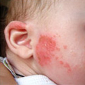 Как вылечить у ребенка аллергию