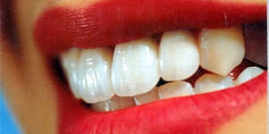 Белоснежные зубы: все методы осветления