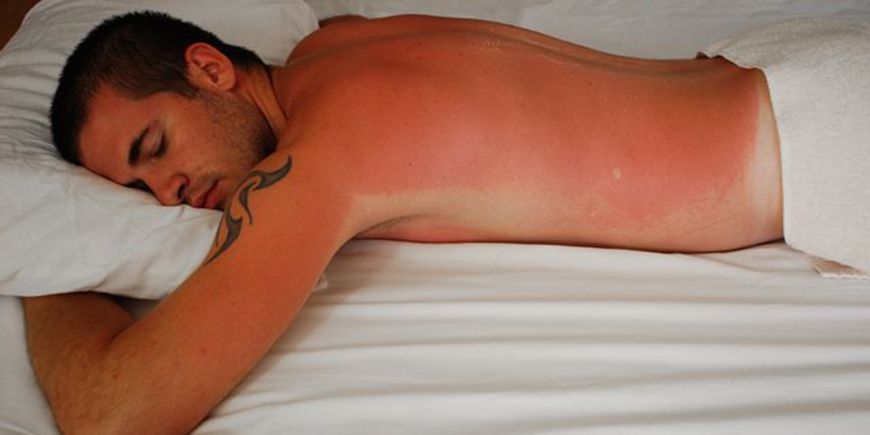 Как спасти кожу при солнечных ожогах